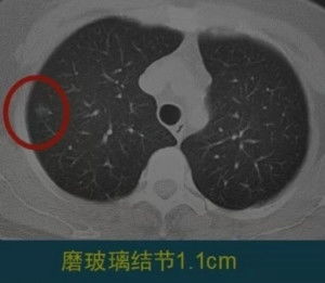 经验丰富的女性肺部健康提醒：3个原因建议您摘除肺混合磨玻璃结节