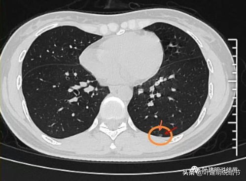 经验丰富的女性肺部健康提醒：3个原因建议您摘除肺混合磨玻璃结节