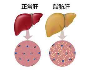 中国糖尿病患者非酒精性脂肪肝患病率高达惊人，新研究揭示潜在疗法