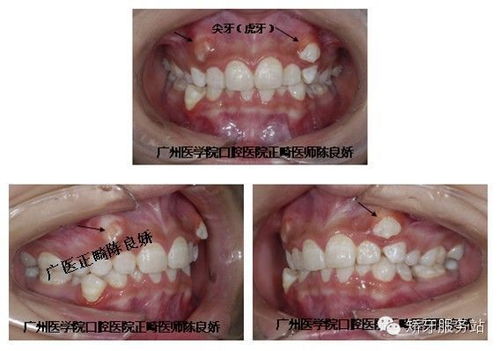 眼底丝状疣的治疗方法：专业建议与选择