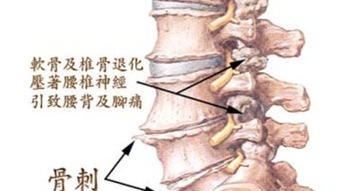 防止颈椎骨质增生：做好基础治疗是关键