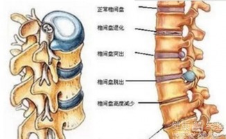 防止颈椎骨质增生：做好基础治疗是关键