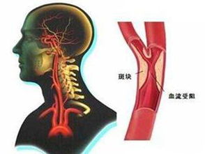 血管狭窄并非绝对要下支架？心脏造影还有误差存在，重要的是就医习惯和定期检查