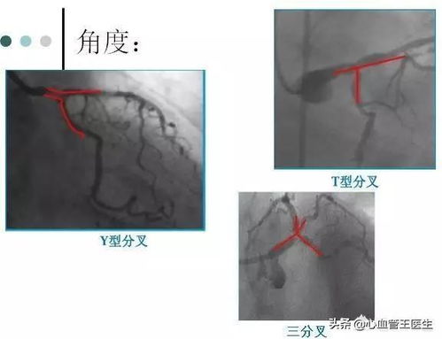 血管狭窄并非绝对要下支架？心脏造影还有误差存在，重要的是就医习惯和定期检查