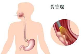 警惕：吃出的食管癌？你的喉咙是否曾被误解为咽炎？