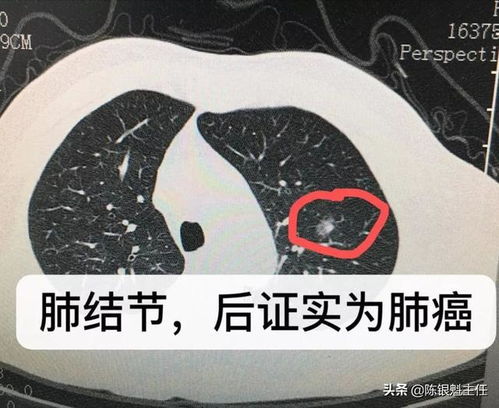 长期忽视肺部炎症风险？医生提醒：发现肺结节已长大3年未查，别再掉以轻心！