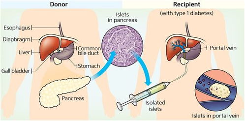 世界首例自体再生胰岛移植成功，慢性糖尿病患者重获新生
