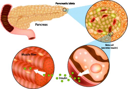 世界首例自体再生胰岛移植成功，慢性糖尿病患者重获新生