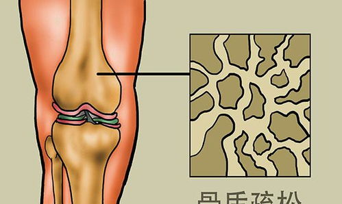 大学生患病痛苦，医生警告：这种病会导致骨骼断裂