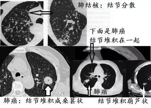 《直播预告：找出肺结节，究竟要不要切？》——请警惕过度治疗的威胁

精彩直播！探寻肺结节真相，避免过度治疗的风险——寻找关键提示！

专家解读：透视肺结节，必要还是过度？主播提前揭秘！

点击直播，了解肺结节，辨别诊断，掌握最佳治疗方案——风险与机遇并存！