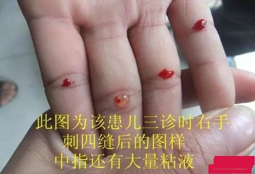 立夏后谨防儿童高热与流口水病症：一项全面指南