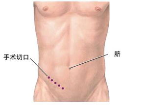 急性阑尾炎的症状、诊断及治疗：牢记3点，有效预防
理解急性阑尾炎的常见症状、治疗方法及预防措施