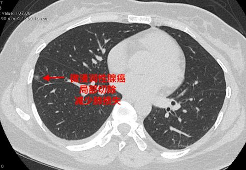 4mm肺磨玻璃结节术后病理诊断结果令人惊讶：微浸润癌?