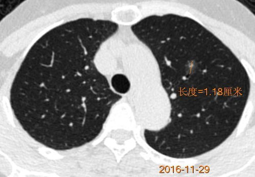 4mm肺磨玻璃结节术后病理诊断结果令人惊讶：微浸润癌?