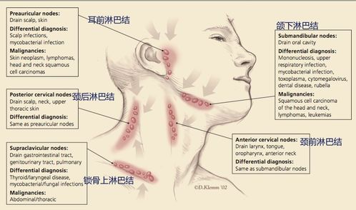 您的孩子脖子上有淋巴结肿大？这是不是结核的症状?