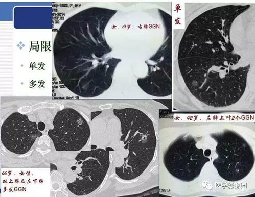 胸肺ct发现实性成分的磨玻璃结节需要认真对待与处理