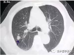 胸肺ct发现实性成分的磨玻璃结节需要认真对待与处理