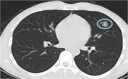 胸肺ct发现实性成分的磨玻璃结节需要认真对待与处理