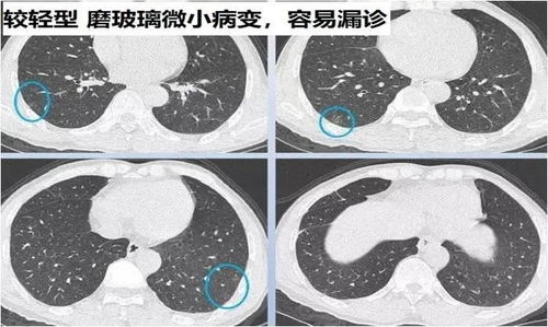 胸肺ct发现实性成分的磨玻璃结节需要认真对待与处理