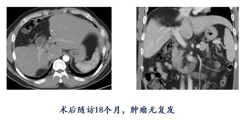 福建医生团队半小时成功破解巨块型肝癌难题