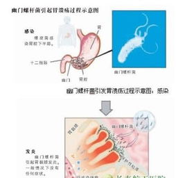 新研究揭示：幽门螺杆菌根治疗程的优化策略，为患者带来更高效治疗方案