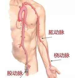 深入解析心血管病体检的必要性：直接冠脉造影是否是最好的选择？