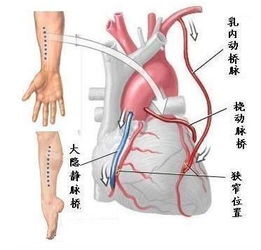 深入解析心血管病体检的必要性：直接冠脉造影是否是最好的选择？