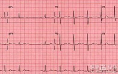 全新：3种关键成分的心律失常护理要点