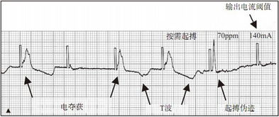 全新：3种关键成分的心律失常护理要点