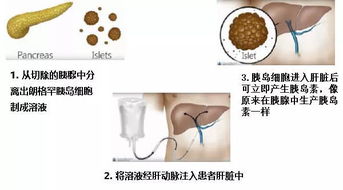 内分泌专家解读：自体再生胰岛移植在糖尿病治疗中的前景如何？