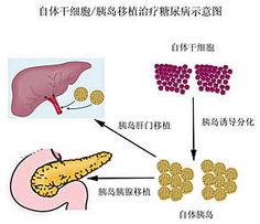 内分泌专家解读：自体再生胰岛移植在糖尿病治疗中的前景如何？