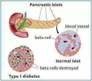 内分泌专家解读：自体再生胰岛移植在糖尿病治疗中的前景如何？