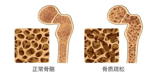 你的健康！骨质疏松早期迹象四点不容忽视