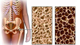 你的健康！骨质疏松早期迹象四点不容忽视