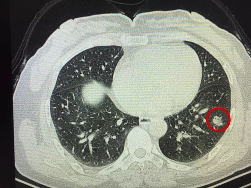 患肺结节不必惊慌，只需定期检查，大部分为良性病变