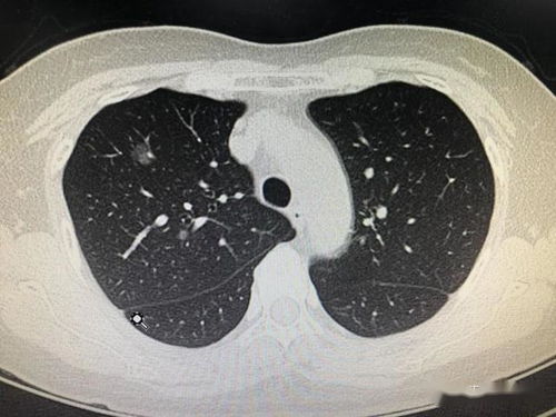 患肺结节不必惊慌，只需定期检查，大部分为良性病变