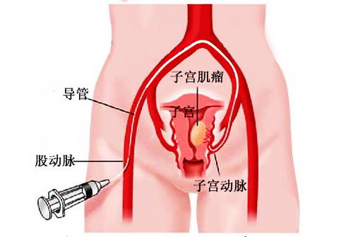 史上最严重！子宫肌瘤竟然已突破心脏边界，真相令人惊恐