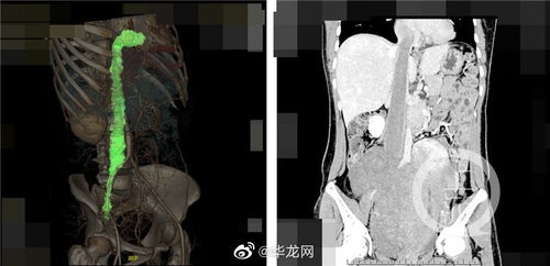 史上最严重！子宫肌瘤竟然已突破心脏边界，真相令人惊恐