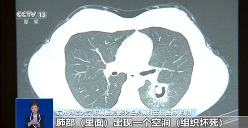 女子高烧三天竟因清理衣柜引发，这是什么情况？你需要知道的可能信息