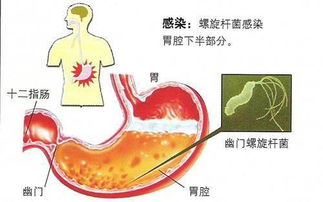 务必警惕：幽门螺杆菌如何威胁你的口气健康，快看是否有异味