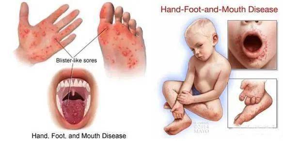 手足口病高发季，提醒您关注孩子的口腔、手脚、臀部等关键部位