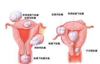 决定是否需要子宫肌瘤手术？需要了解的事项和可能的影响