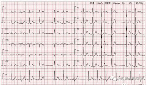 胎宝心电图揭示隐藏病因：持续性心律失常的真相