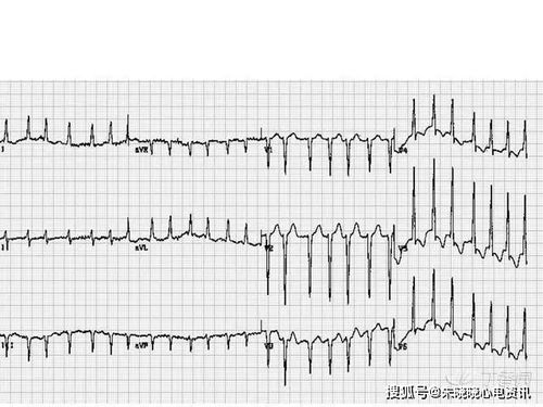 胎宝心电图揭示隐藏病因：持续性心律失常的真相