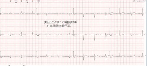 胎宝心电图揭示隐藏病因：持续性心律失常的真相