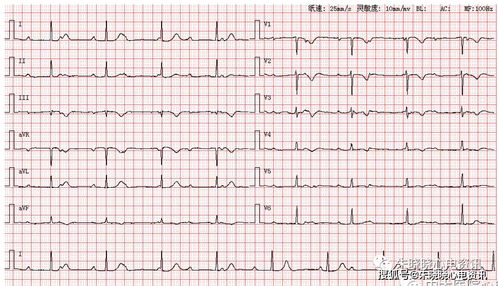 胎宝心电图揭示隐藏病因：持续性心律失常的真相