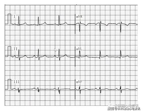胎宝心电图揭示隐藏病因：持续性心律失常的真相