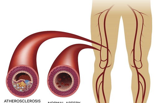 血管钙化真的不能治愈吗？为什么这个病症如此重要，应该如何了解和管理?