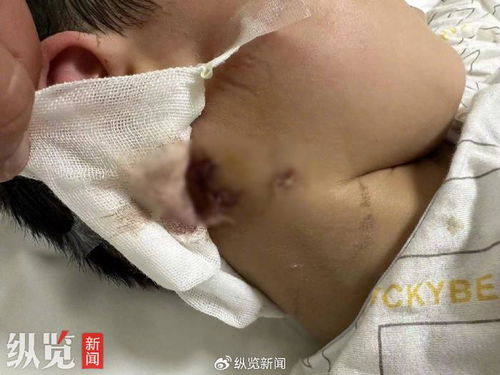 为何一岁的3岁男孩被恶犬咬伤18天后不幸离世？我们一直在寻找答案