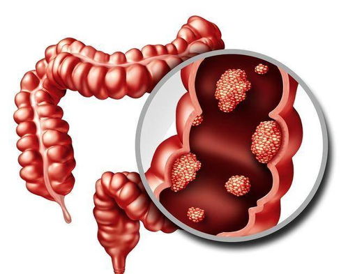 疾病风险提示：哪些人患大肠癌风险较高？早发现、早治疗，抓住治疗黄金期

保护你的健康：哪些人易患大肠癌？早期发现，科学治疗

早知道早预防：大肠癌的风险因素及如何预防？

了解风险因素，预防大肠癌：哪些人容易患上大肠癌？